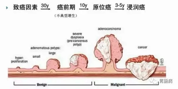 體檢查出腸息肉一定要切除！ 95%腸癌由它演變而來(lái)