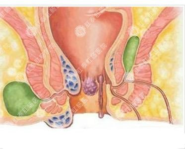 南寧哪個(gè)醫院可以做肛周膿腫？