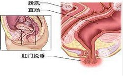 南寧治療脫肛哪家醫院好？南寧脫肛治療多少錢(qián)？